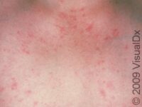 Telangiectasia