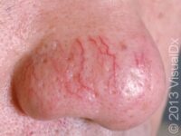 Telangiectasia