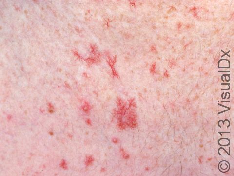 This image displays an area of sun-damaged skin with multiple telangiectasias.