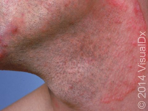 This image displays a circular border of tinea (ringworm), which is most evident on the neck, but it is also seen on the cheek.