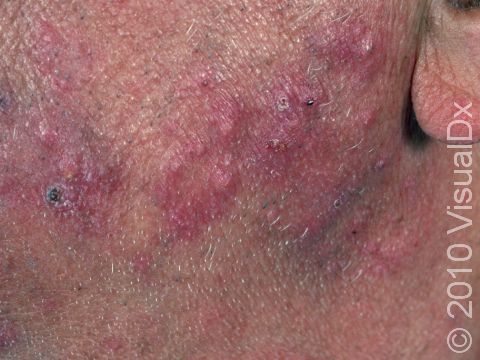 This individual has fungal infection of the hair follicles, leading to multiple red bumps and crusts rather than a circle shape of typical ringworm on the skin surface.