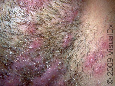 Multiple inflammatory elevations of the skin around the hair follicle are typical of fungal infections in the beard area.