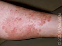 Ringworm (Tinea Corporis)