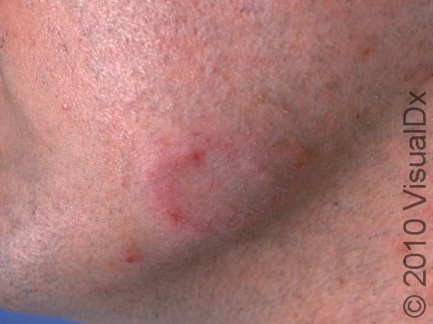 This image displays an early area of tinea on the jaw with a C-shaped, swollen, red area that is slightly scaly.