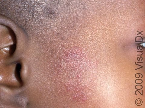 Early forms of fungal infections, such as this image displaying tinea faciei, can appear as a mild area of skin redness and scaling.