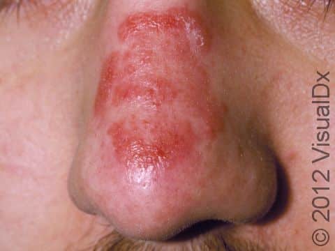 A red, slightly elevated lesion with scaling along the edge is typical of tinea faciei.