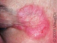 Ringworm, Facial (Tinea Faciei)