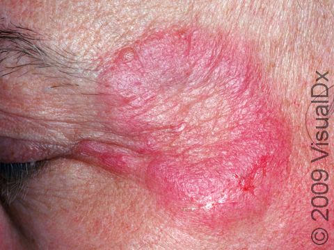 Fungal infections on the face are known as tinea faciei, as displayed in this image.