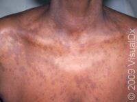 Tinea Versicolor