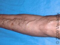 Varicose Veins (Varicosities)