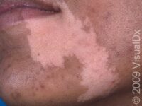 Vitiligo