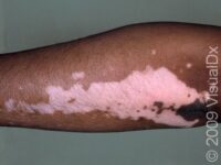 Vitiligo