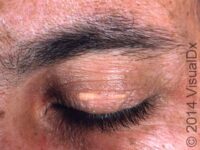 Xanthelasma Palpebrarum