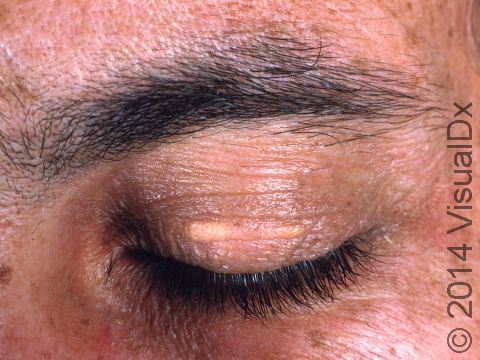 Slightly elevated lesions of xanthelasma can occur on the middle of the eyelids.