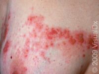 Shingles (Zoster)