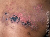 Shingles (Zoster)