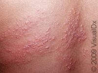 Shingles (Zoster)