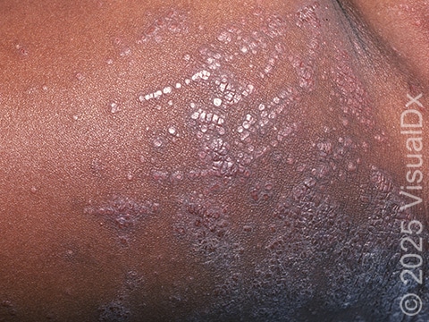 Atopic dermatitis (eczema) in patients with darker skin often has prominent, small bumps that join to form larger areas of dry, scaling skin.