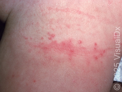 This image displays redness with small bumps caused by diaper irritation.