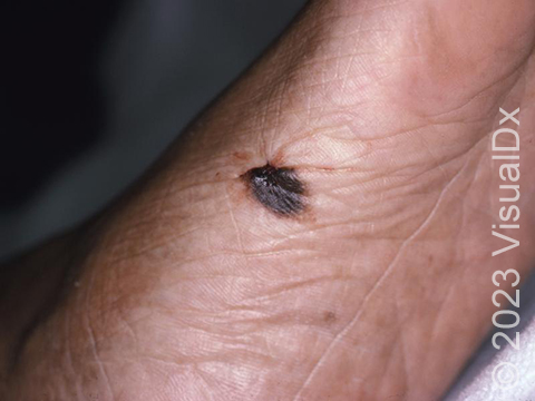 An irregularly pigmented skin lesion of the foot, consistent with malignant melanoma.