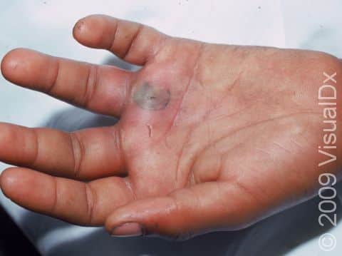 Abscess – Child