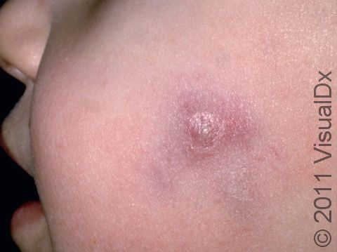 Abscess – Infant