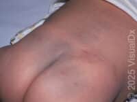 Congenital Dermal Melanocytosis (Blue-Gray Spot) – Infant