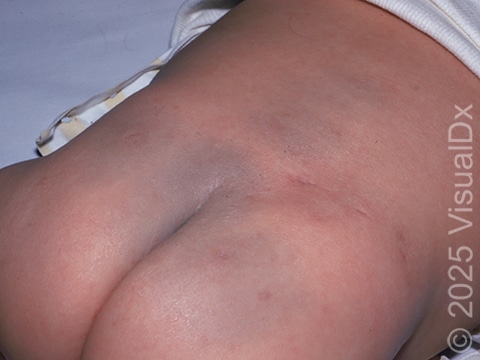 Congenital Dermal Melanocytosis (Blue-Gray Spot) – Infant