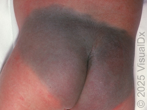 Blue-gray spots (congenital dermal melanocytosis) can cover the entire buttocks, as in this newborn.