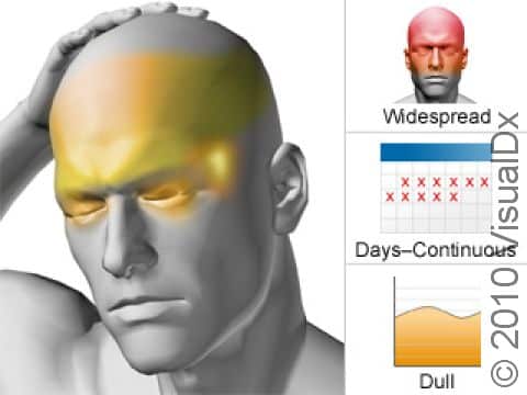 Chronic tension headaches involve mild-to-moderate head discomfort, generally on both sides of the head. A chronic tension headache is present for 15 or more days a month for at least 3 months.