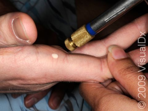 Cryotherapy (liquid nitrogen) treatment of a flat wart on the hand.