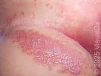 Diaper Dermatitis (Candidiasis) – Infant