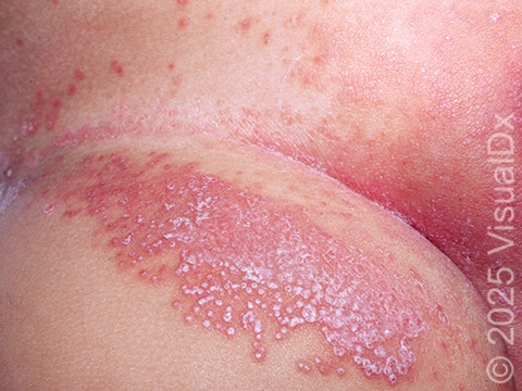 Red, swollen, raised patches with small surrounding bumps (some pus filled) on the upper thigh.