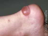 Blisters, First Aid