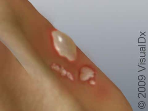 The grouped blisters in this image exemplify the type of multiple, grouped blisters that you should not attempt to drain. Further, this type of blister configuration should warrant a visit to a medical professional