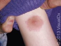 Bug Bites or Stings, First Aid