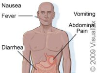 Foodborne Illness (Food Poisoning), First Aid