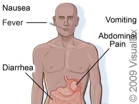 Foodborne illness signs and symptoms can include nausea, fever, diarrhea, abdominal pain, and sometimes vomiting.