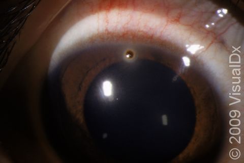 A small corneal foreign body, as displayed here, may not be seen without close inspection.