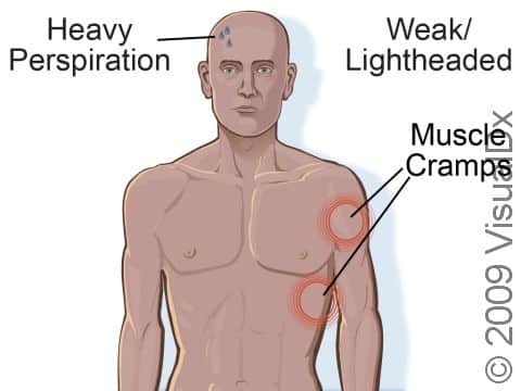 Heat cramp signs and symptoms can include heavy perspiration, muscle cramps (often in the legs, arms, abdomen, and back), and weakness / lightheadedness.