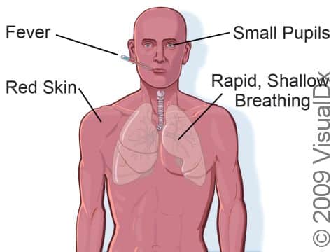 Heatstroke signs and symptoms can include fever; red skin; small pupils; rapid, shallow breathing; rapid, weak pulse; lack of sweating; extreme confusion or irritability; weakness; seizures; or unconsciousness.