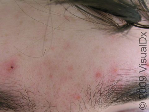 BEFORE: This patient wanted the appearance of his acne scars on his forehead minimized by laser treatment.