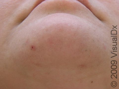 AFTER: Two laser hair removal treatments were performed. This picture is 7 months posttreatment.