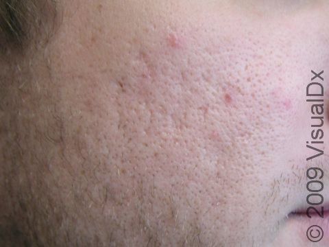 BEFORE: This person wanted the appearance of his acne scars minimized by laser treatment.