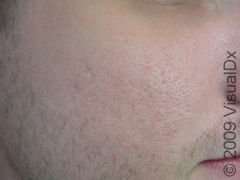 AFTER: Following fractional resurfacing for laser skin renewal, the appearance of this person's acne scars has been reduced.