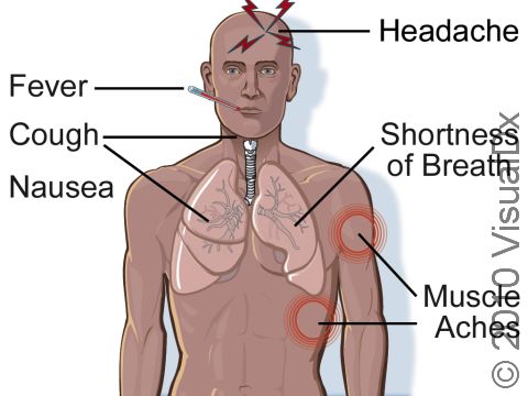 The early symptoms of avian influenza are remarkably similar to influenza (the 