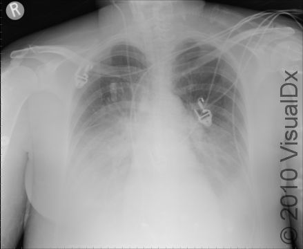 Chest x-ray showing bilateral lower lobe infiltrates consistent with diagnosis of Legionnaire's disease.