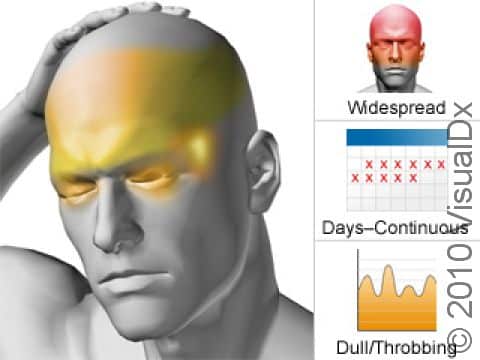 Medication overuse headache is a chronic headache syndrome that typically involves dull, moderately intense pain that can last for several days.