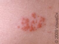 Sacral Herpes – Adult