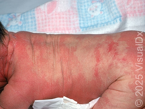 Seborrheic dermatitis can be severe, involving many skin areas.